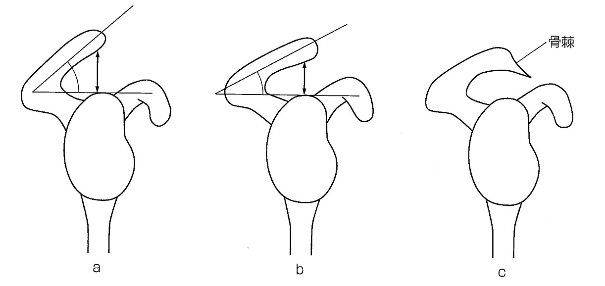 肩甲骨Ｙ撮影による肩峰の傾斜